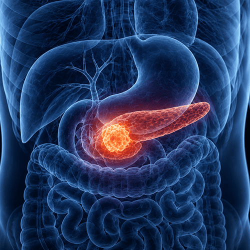 Ilustração anatômica do sistema digestivo com destaque no pâncreas, evidenciando tumor pancreático em imagem médica.