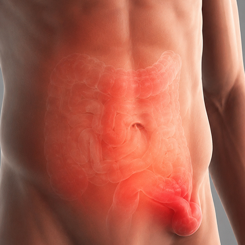 Ilustração do abdômen com o intestino em transparência e destaque em vermelho na região da virilha, indicando a área da hérnia inguinal.
