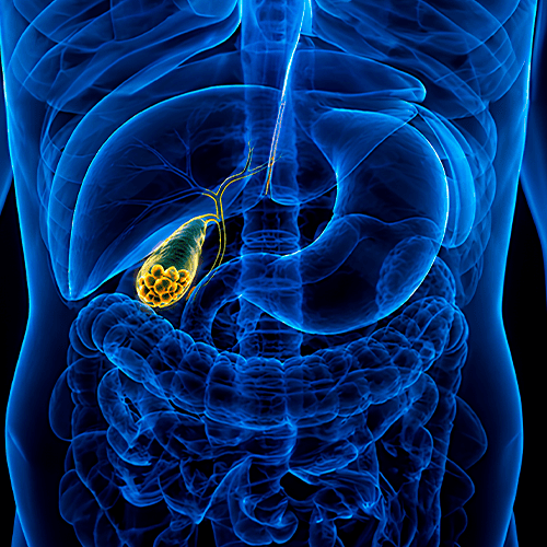 Ilustração anatômica do sistema digestivo em transparência, com fígado, estômago, intestinos e vesícula biliar em destaque, mostrando cálculos no interior da vesícula.