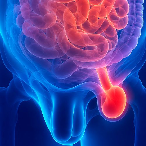 Ilustração médica de hérnia inguinal na região abdominal