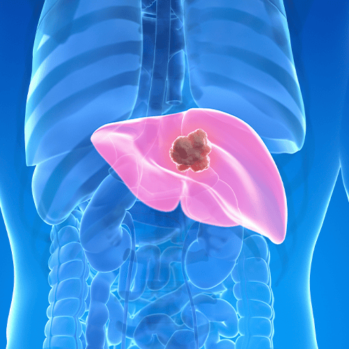 Ilustração médica de nódulo no fígado